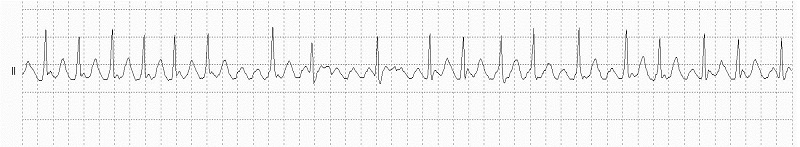 Atrial Flutter